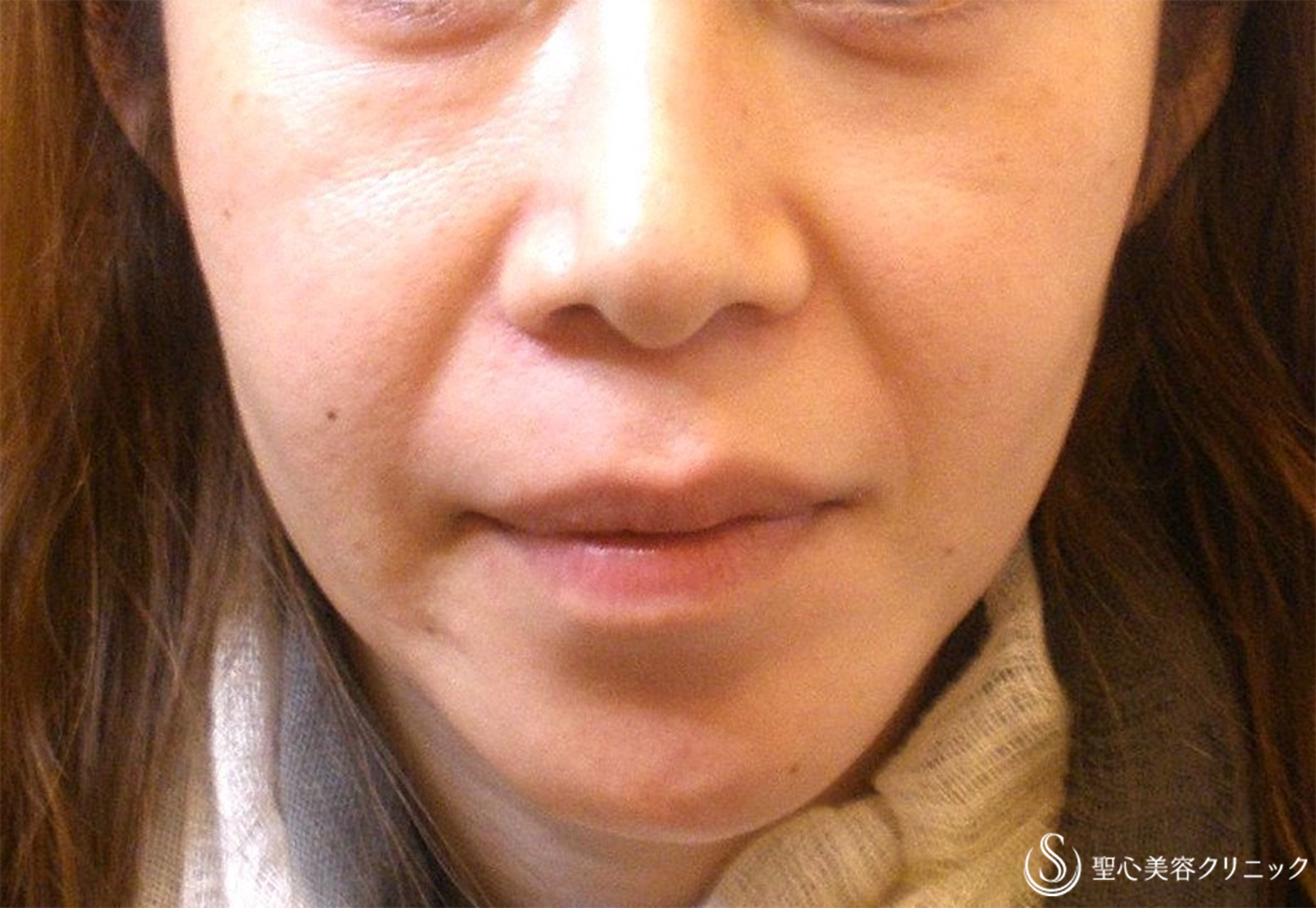 【40代女性・目の下、ほうれい線】プレミアムPRP皮膚再生療法（術後12年） Before 