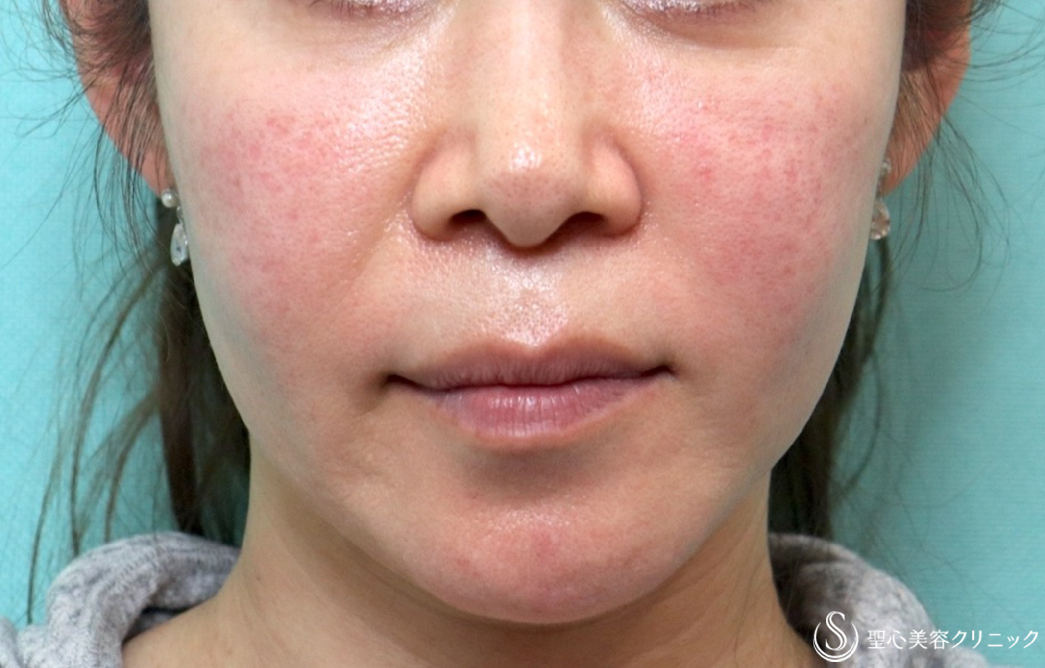 【40代女性・目の下、ほうれい線】プレミアムPRP皮膚再生療法（術後12年） After 