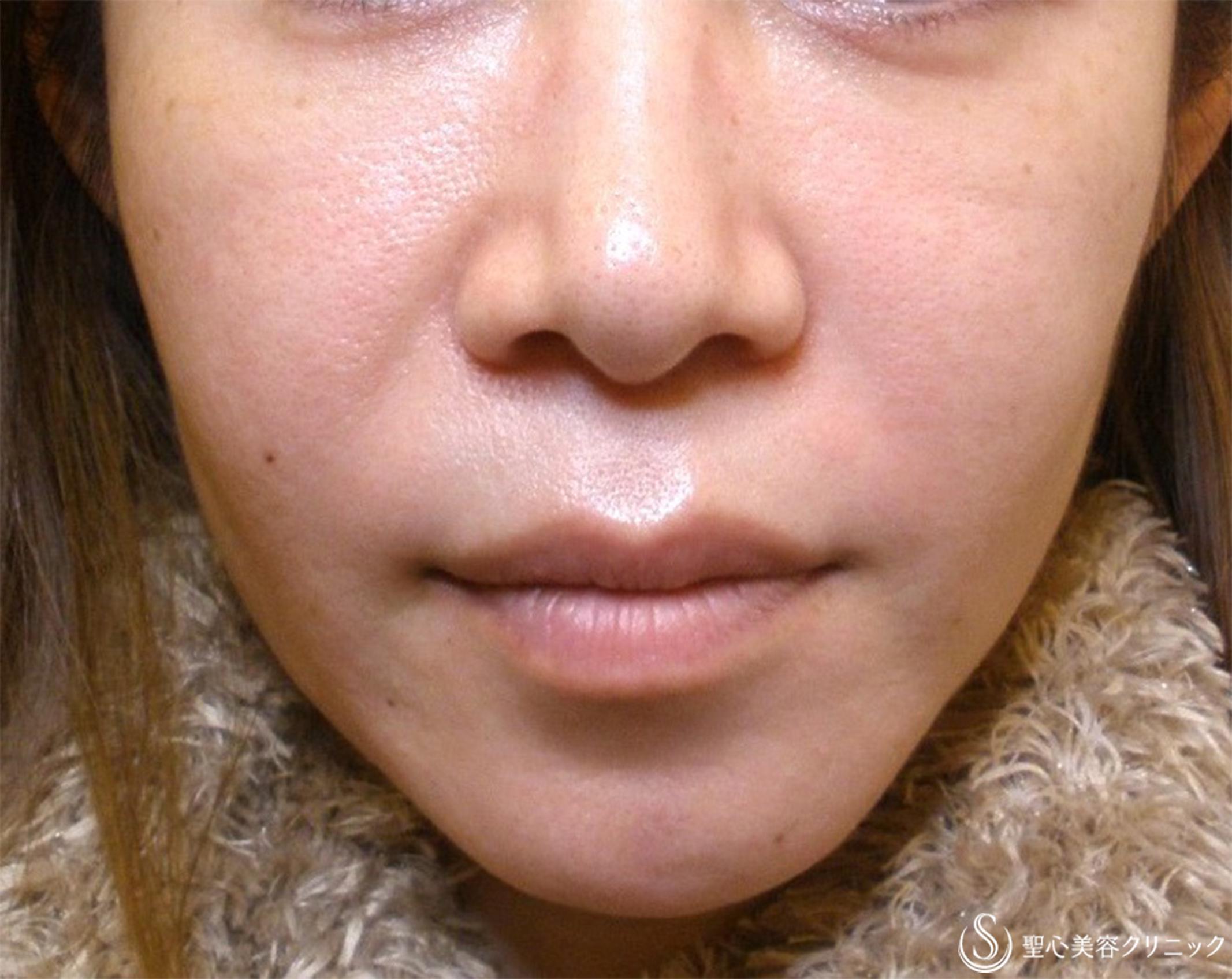 【40代女性・目の下、ほうれい線】プレミアムPRP皮膚再生療法（術後12年） After 