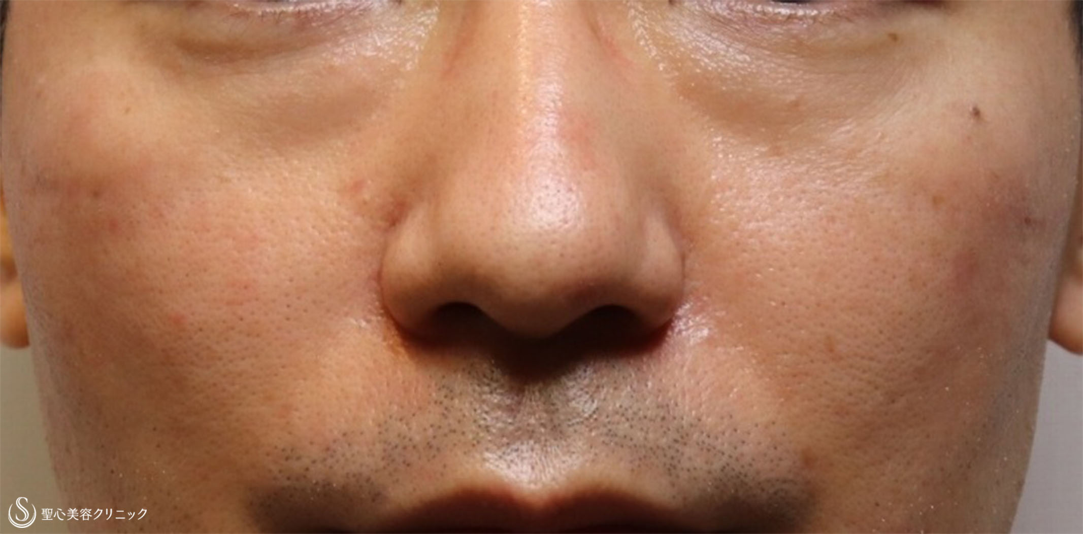 【40代男性・疲れ顔を改善】プレミアムPRP皮膚再生療法、目の下＆ほうれい線（術後5ヶ月半） Before 