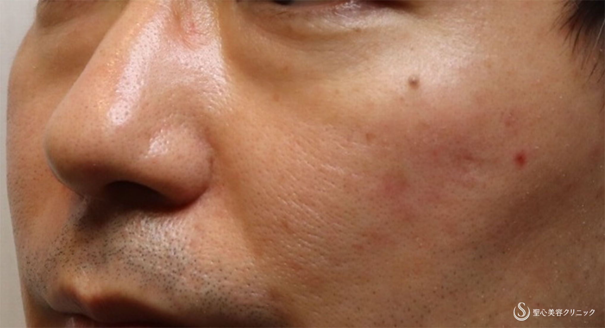 【40代男性・疲れ顔を改善】プレミアムPRP皮膚再生療法、目の下＆ほうれい線（術後5ヶ月半） Before 
