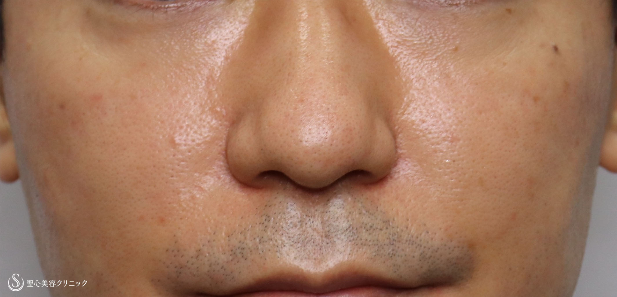 【40代男性・疲れ顔を改善】プレミアムPRP皮膚再生療法、目の下＆ほうれい線（術後5ヶ月半） After 
