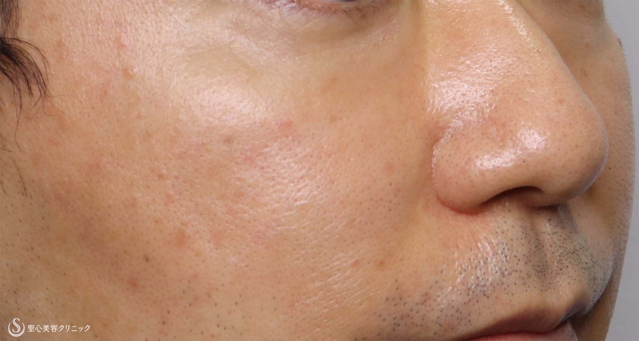【40代男性・疲れ顔を改善】プレミアムPRP皮膚再生療法、目の下＆ほうれい線（術後5ヶ月半） After 