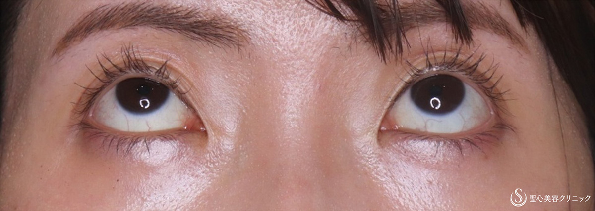 【30代女性・眠そうな目を大きく】眼瞼下垂埋没法（術後2ヶ月） Before 