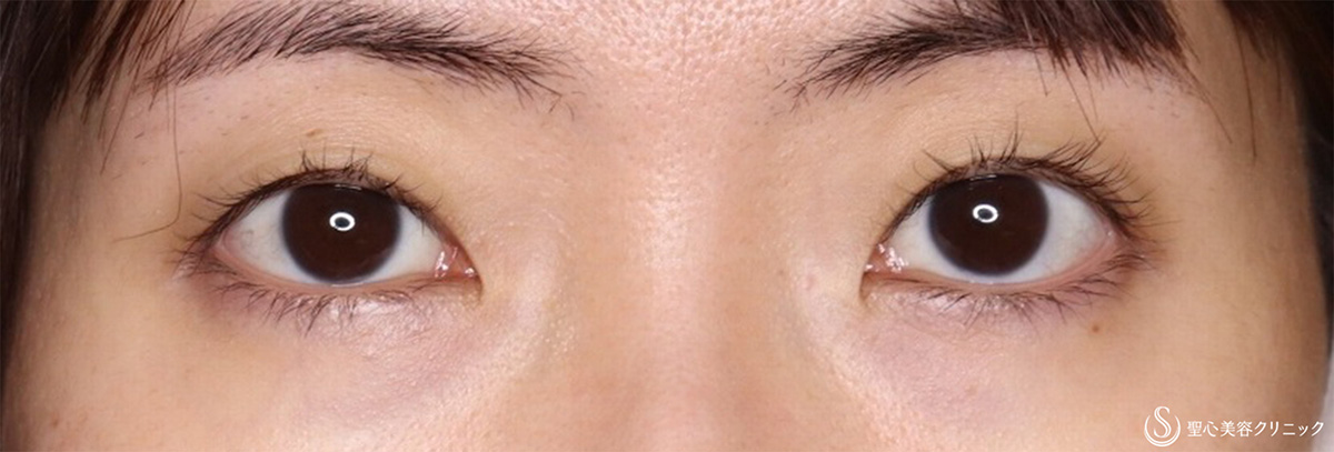 【30代女性・眠そうな目を大きく】眼瞼下垂埋没法（術後2ヶ月） After 