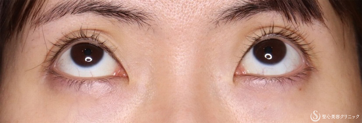 【30代女性・眠そうな目を大きく】眼瞼下垂埋没法（術後2ヶ月） After 