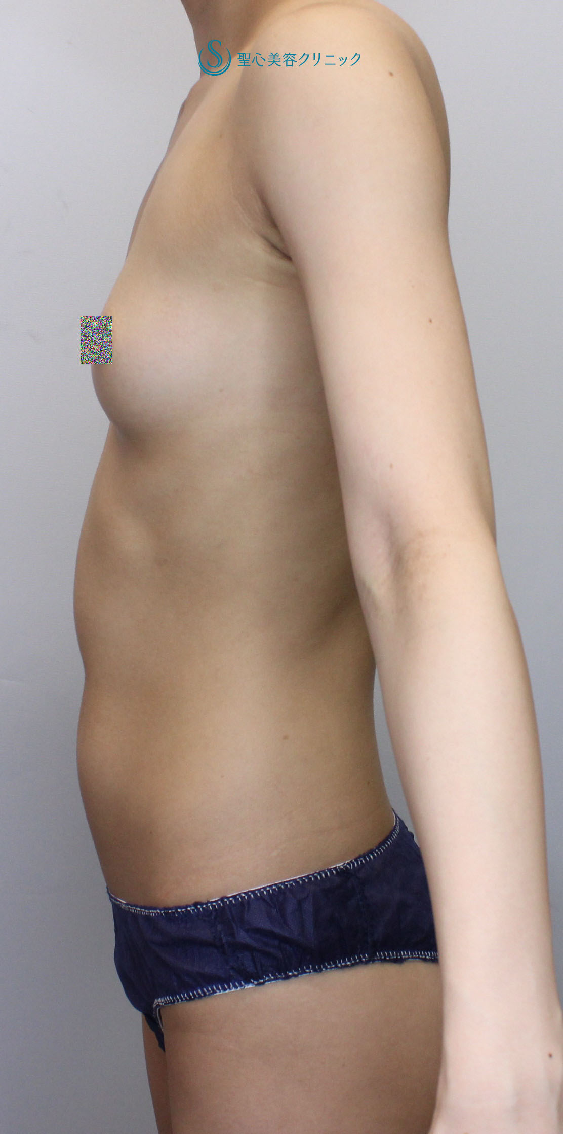 【20代女性・自身の脂肪でバストアップ】ピュアグラフト脂肪注入豊胸術（術後1か月） Before 