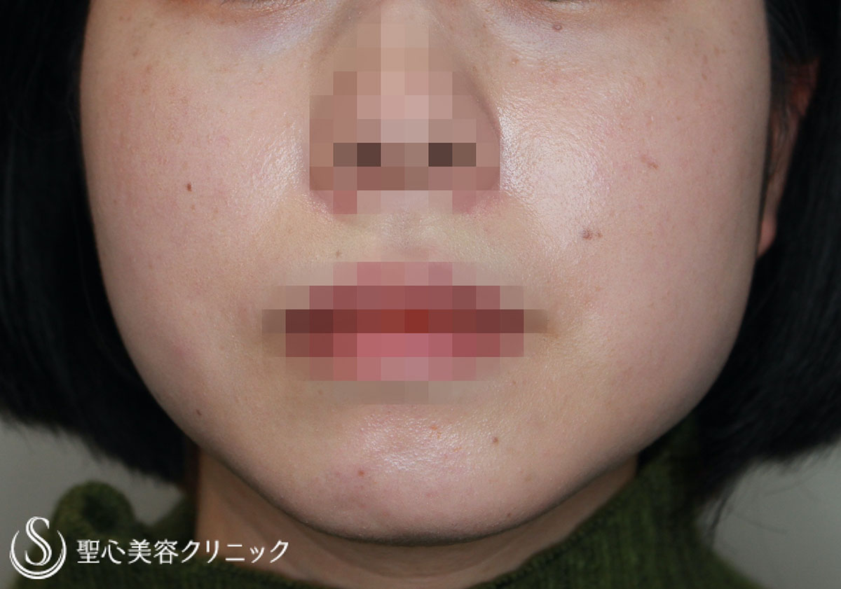 【30代女性・ボトックスで小顔に】エラボトックス（4ヶ月後) Before 