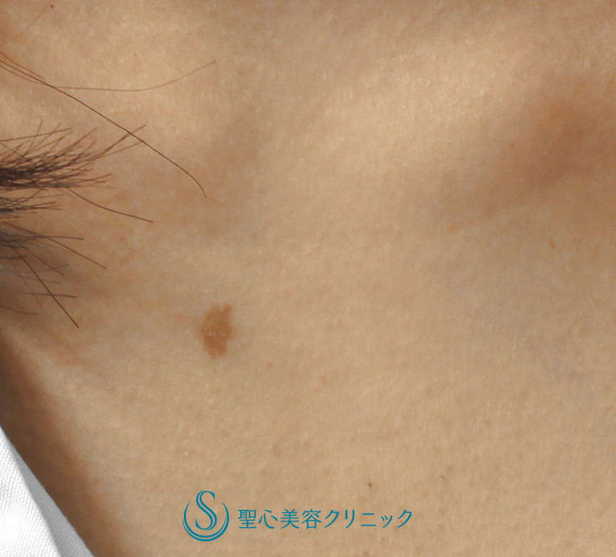 【20代女性・デコルテの生まれつきの茶アザ（扁平母斑）】QスイッチYAGレーザー（術後2か月） Before 