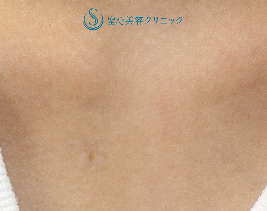 【20代女性・デコルテの生まれつきの茶アザ（扁平母斑）】QスイッチYAGレーザー（術後2か月） After 