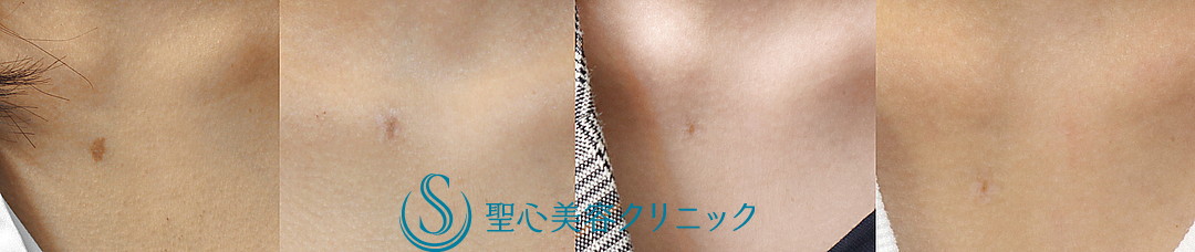 【20代女性・デコルテの生まれつきの茶アザ（扁平母斑）】QスイッチYAGレーザー（術後2か月） After 