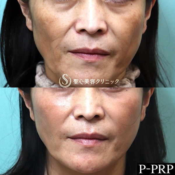 【40代女性・頬のコケ感をなくしたい】プレミアムPRP皮膚再生療法（3ヶ月後） After 