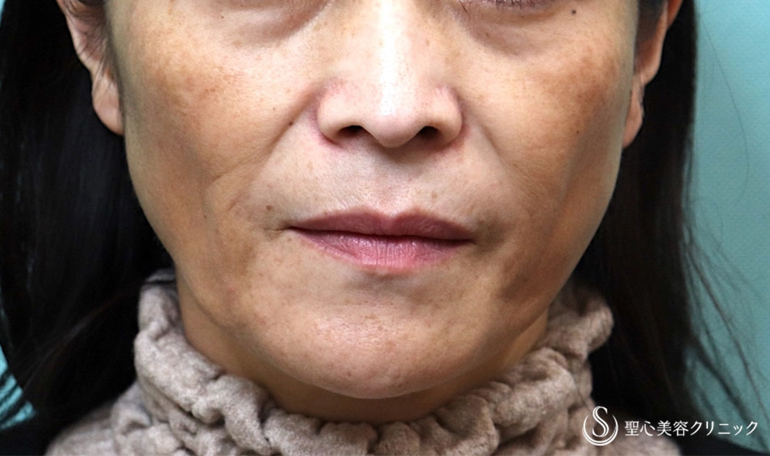 【40代女性・頬のコケ感をなくしたい】プレミアムPRP皮膚再生療法（3ヶ月後） Before 