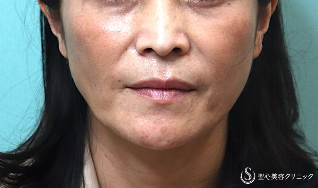 【40代女性・頬のコケ感をなくしたい】プレミアムPRP皮膚再生療法（3ヶ月後） After 