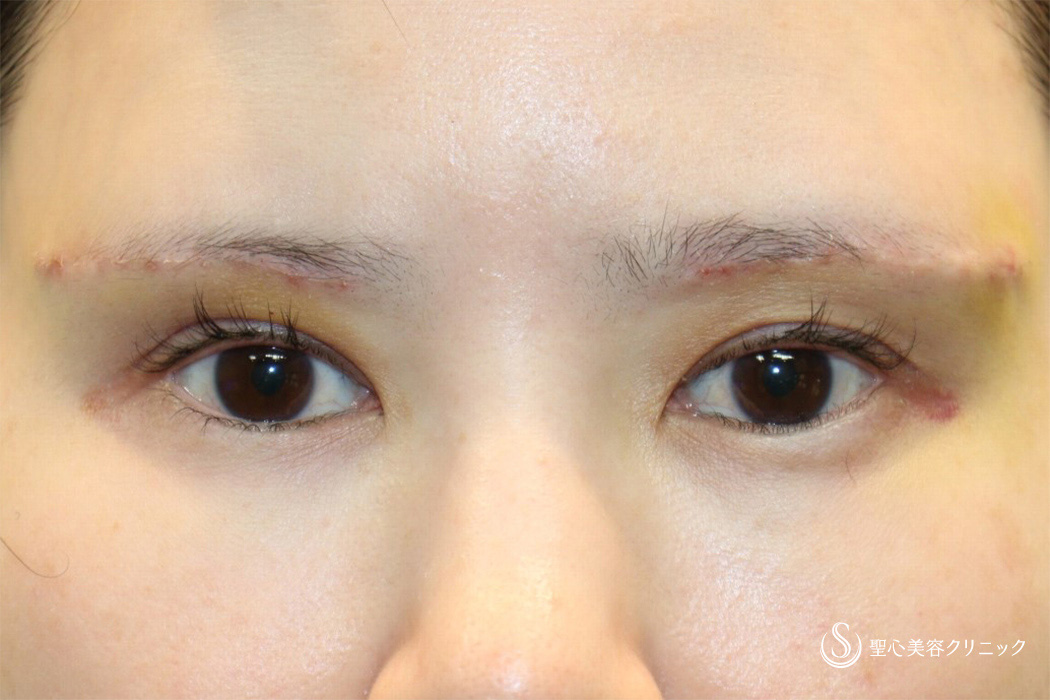 【女性・スタッフの目の上のたるみ処置】眉下切開（術直後～3ヶ月後） After 
