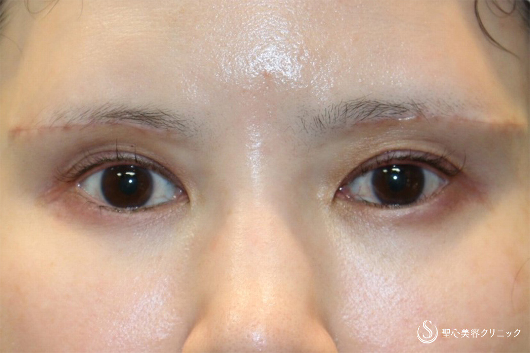 【女性・スタッフの目の上のたるみ処置】眉下切開（術直後～3ヶ月後） After 
