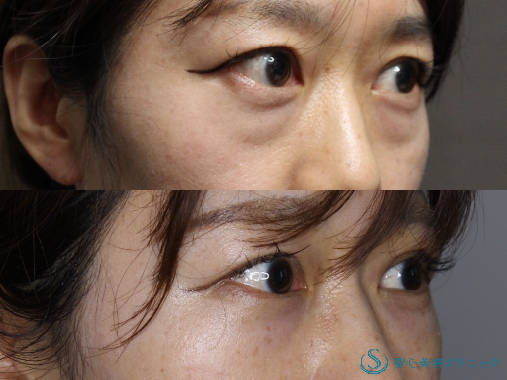 【30代女性・目の下の若返り】プレミアムPRP皮膚再生療法（術後1年） After 