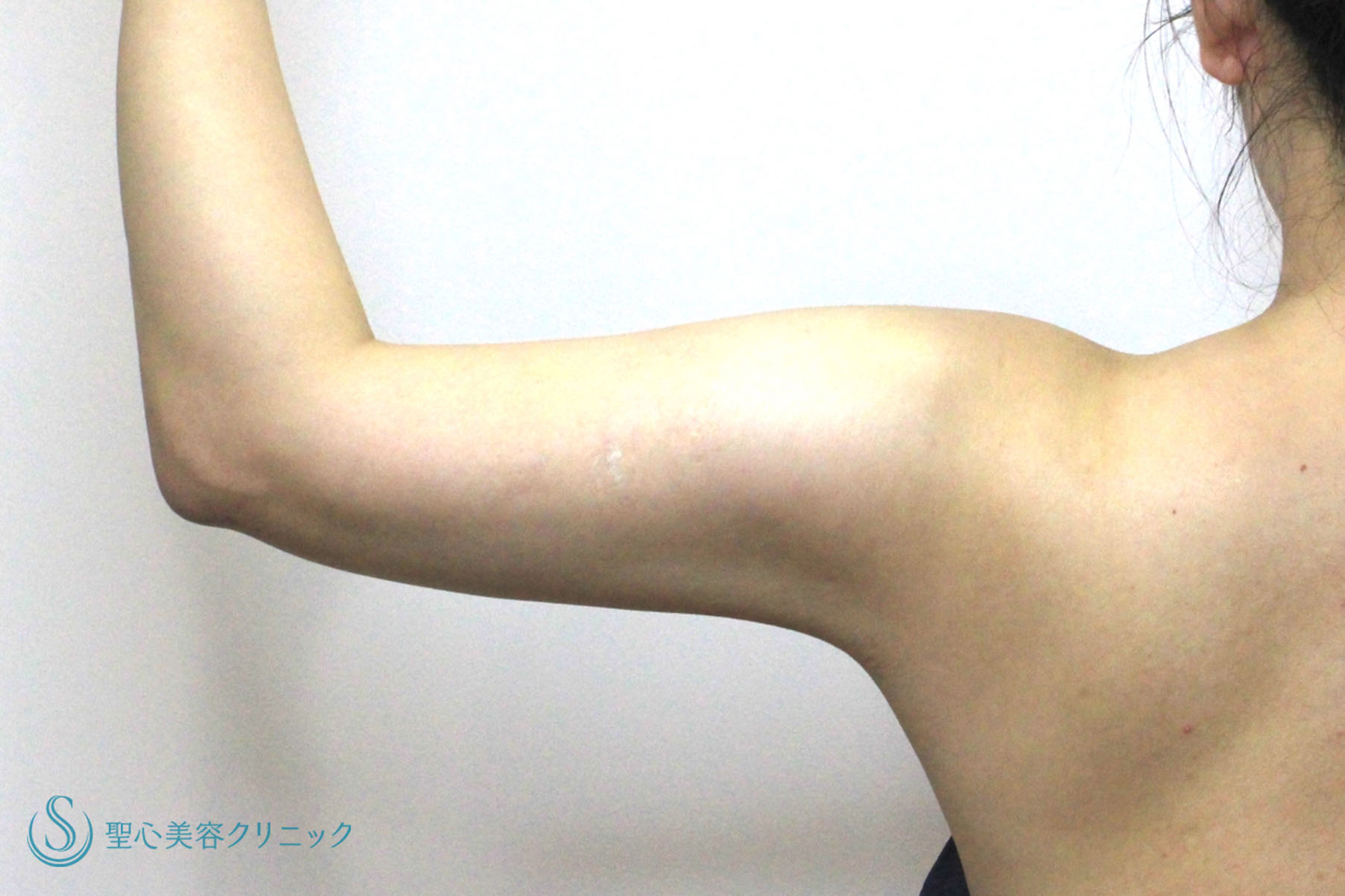 【20代女性・二の腕の脂肪が気になる】ベイザーリポ2.2脂肪吸引（術後半年） After 