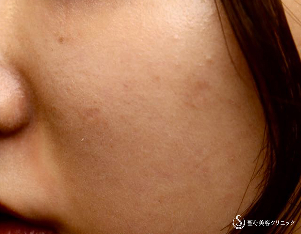 【20代女性・ニキビ跡のクレーターを治したい】プレミアムPRP皮膚再生療法 After 