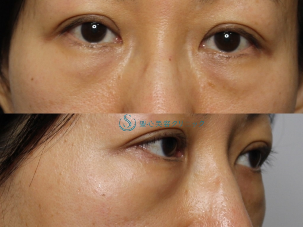 【40代女性・目元を若々しく】結膜側脱脂＋プレミアムPRP皮膚再生治療（術後6か月） Before 