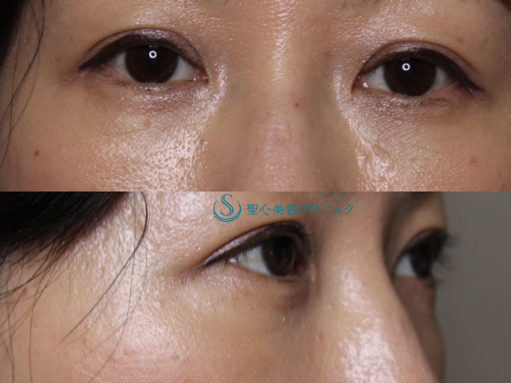 【40代女性・目元を若々しく】結膜側脱脂＋プレミアムPRP皮膚再生治療（術後6か月） After 