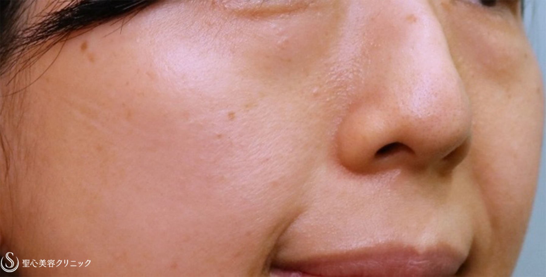 【40代女性・疲れ顔改善】プレミアムPRP皮膚再生療法 目の下・ほうれい線（術後10ヶ月） Before 