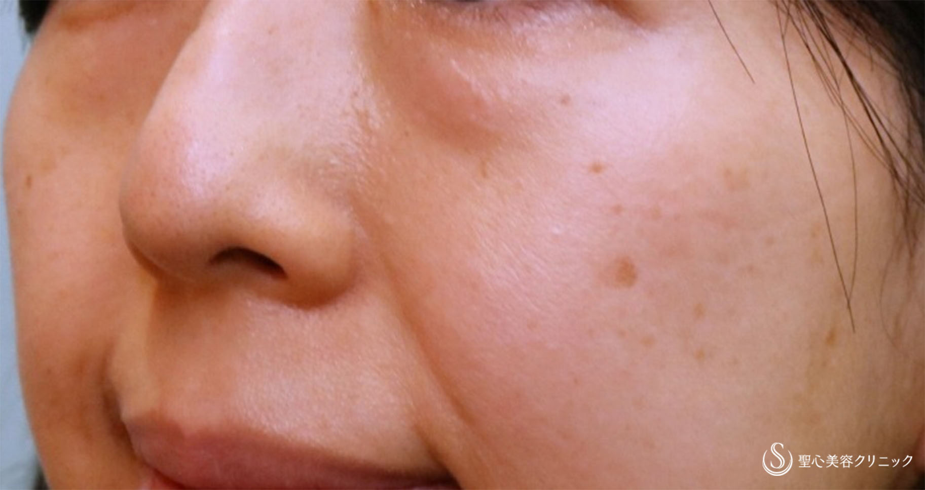 【40代女性・疲れ顔改善】プレミアムPRP皮膚再生療法 目の下・ほうれい線（術後10ヶ月） Before 