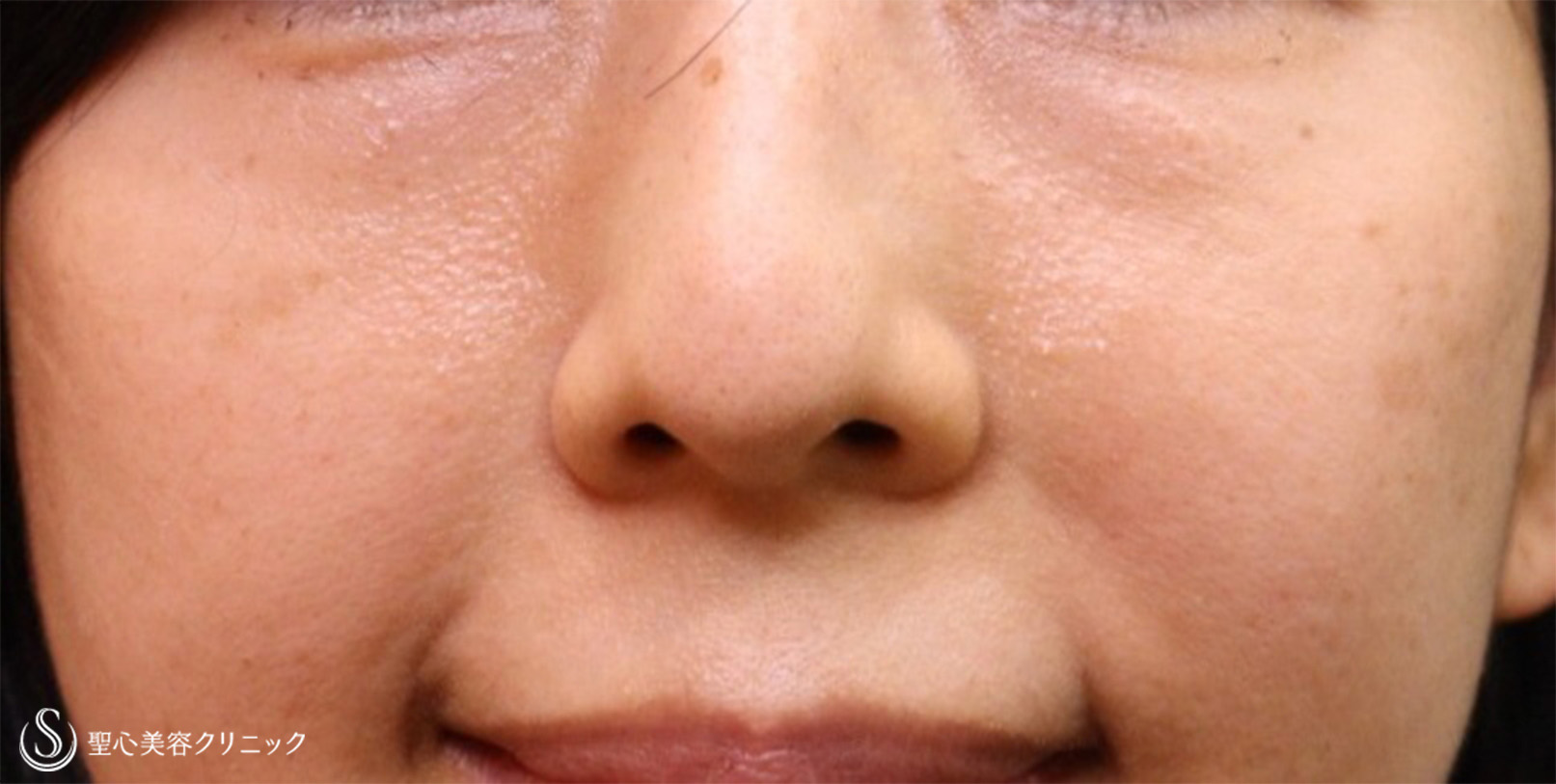 【40代女性・疲れ顔改善】プレミアムPRP皮膚再生療法 目の下・ほうれい線（術後10ヶ月） After 