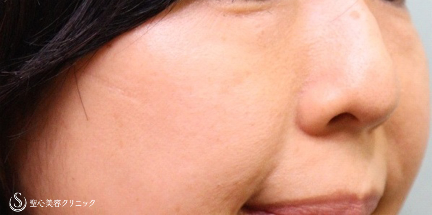【40代女性・疲れ顔改善】プレミアムPRP皮膚再生療法 目の下・ほうれい線（術後10ヶ月） After 