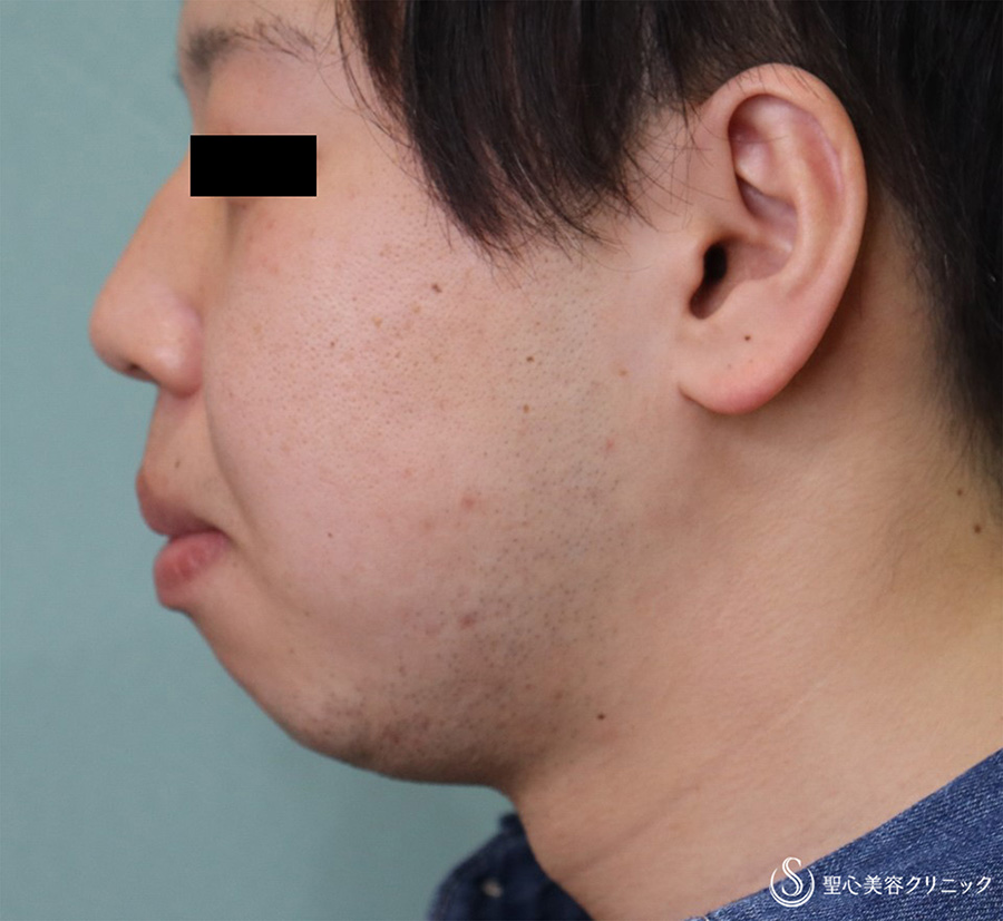 【30代男性・あごの形を整えたい】あごプロテーゼ（術後1か月） Before 