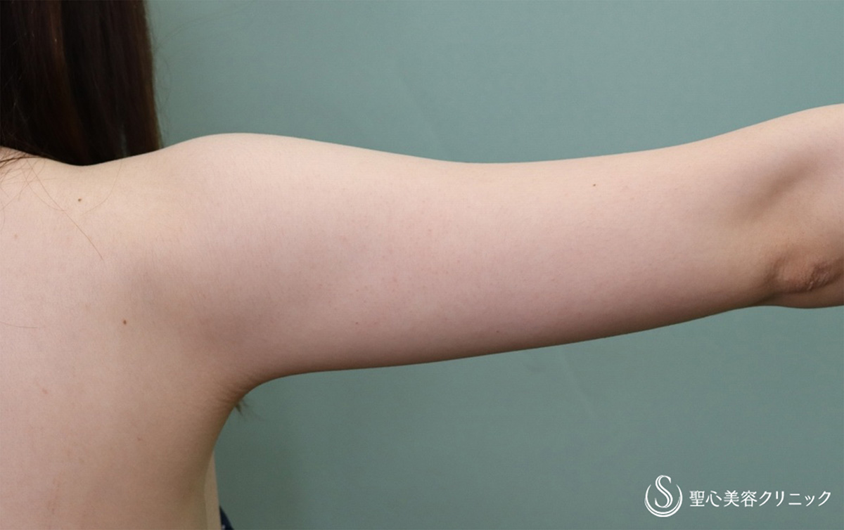 【20代女性・二の腕をすっきり】ベイザーリポ2.2脂肪吸引 上腕（術後1ヶ月） Before 