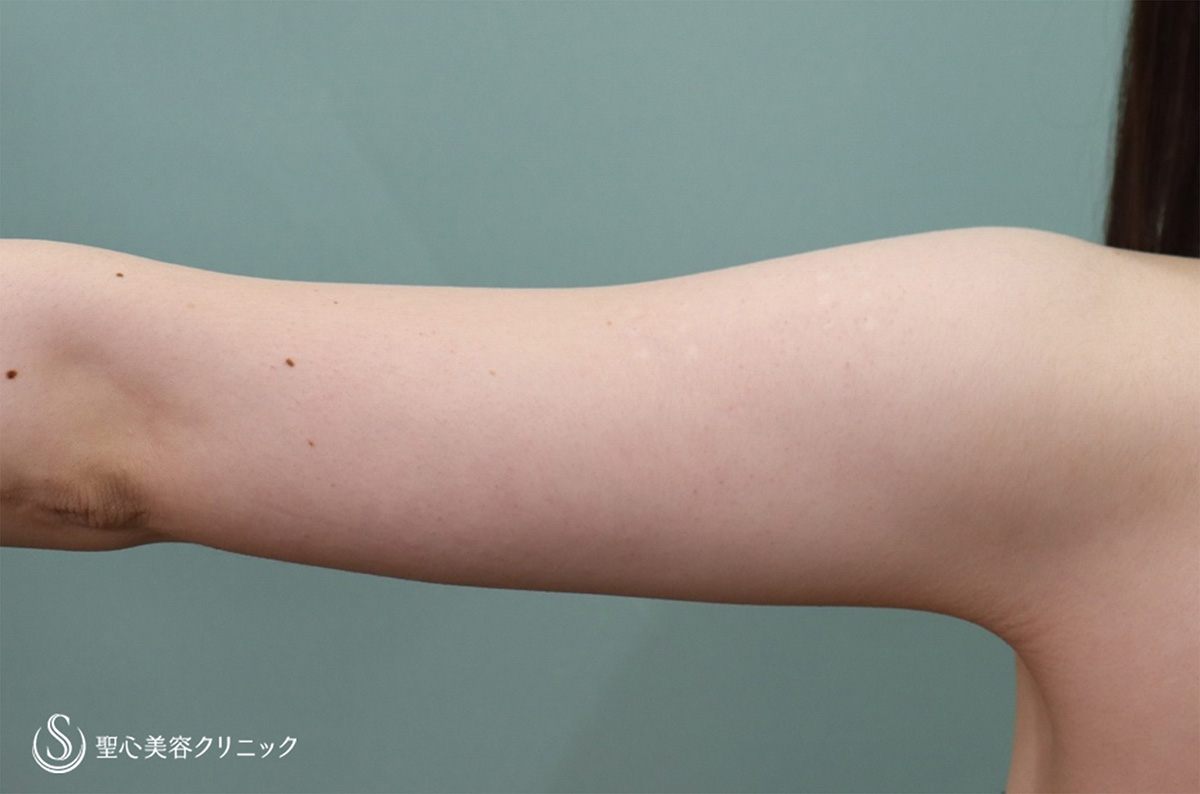 【20代女性・二の腕をすっきり】ベイザーリポ2.2脂肪吸引 上腕（術後1ヶ月） Before 