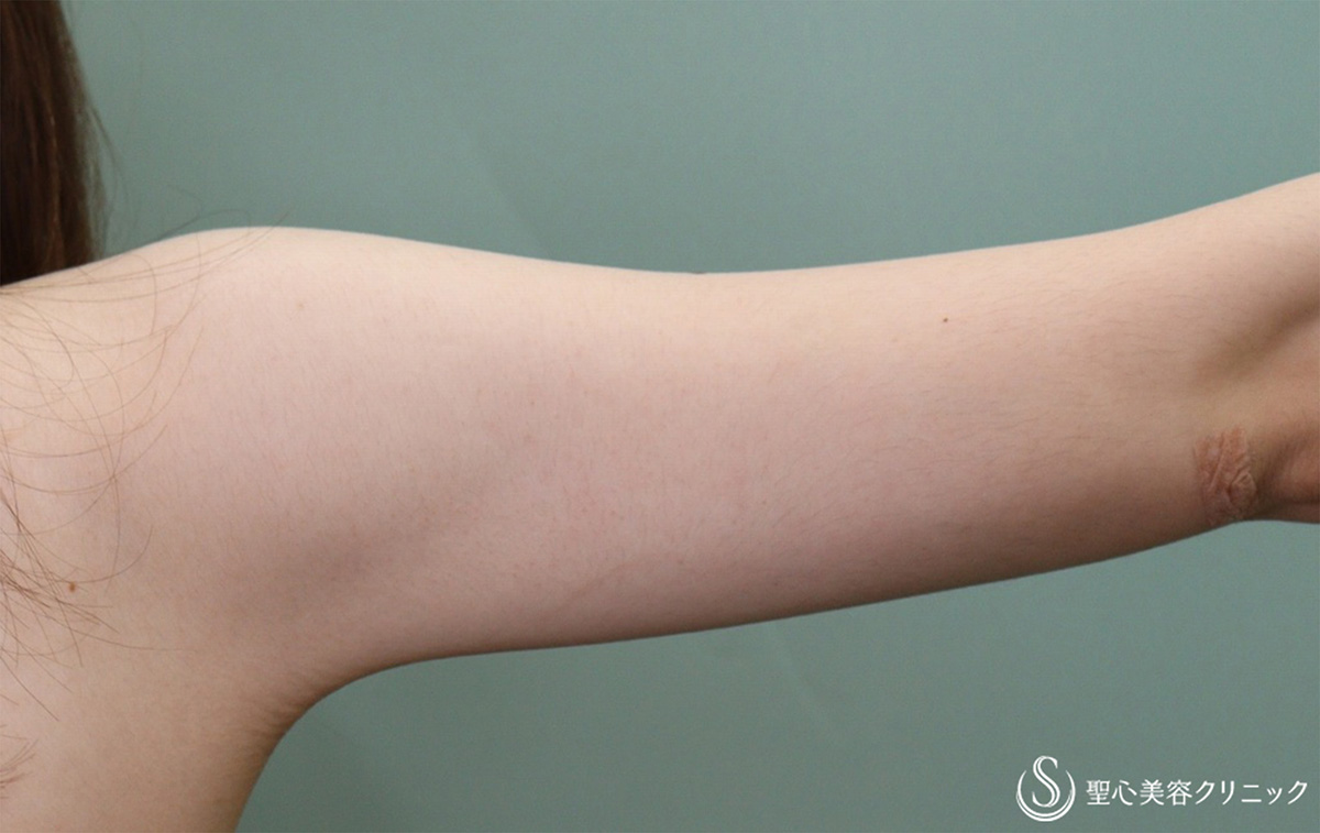 【20代女性・二の腕をすっきり】ベイザーリポ2.2脂肪吸引 上腕（術後1ヶ月） After 