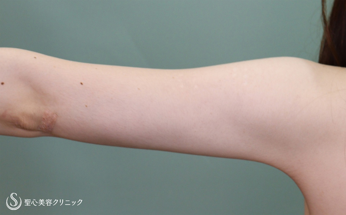 【20代女性・二の腕をすっきり】ベイザーリポ2.2脂肪吸引 上腕（術後1ヶ月） After 