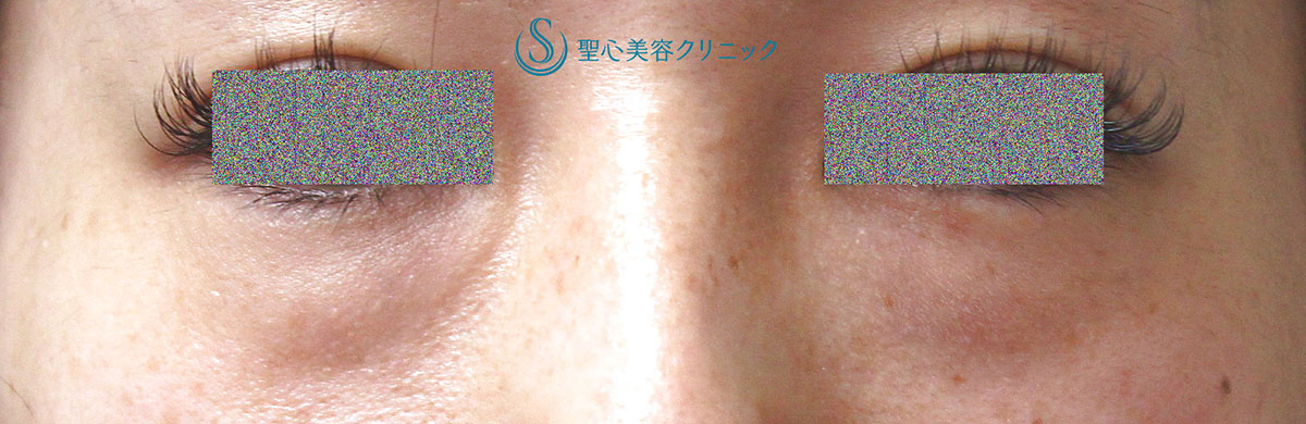 【30代女性・目の下のクマ（窪み）】プレミアムPRP皮膚再生療法（術後11か月） Before 