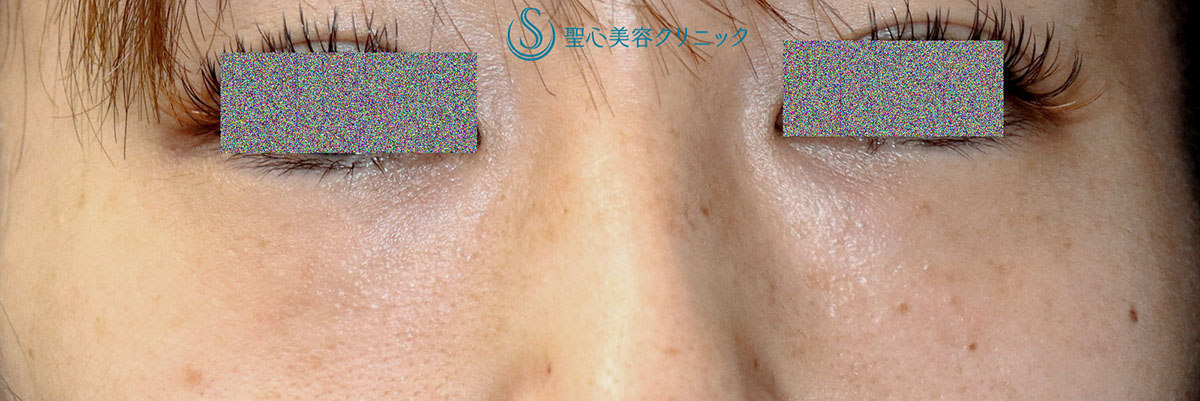 【30代女性・目の下のクマ（窪み）】プレミアムPRP皮膚再生療法（術後11か月） After 