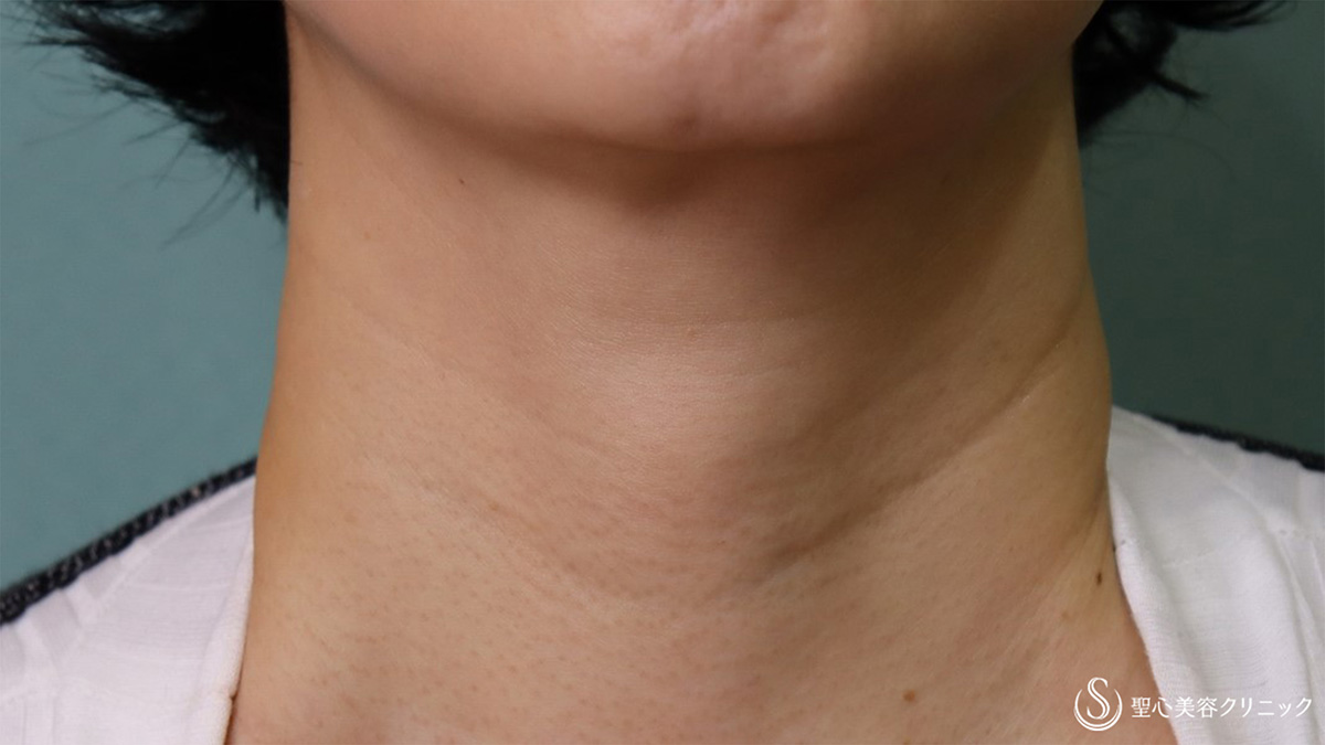 【50代女性・首の横じわ】プレミアムPRP皮膚再生療法（術後11か月） Before 