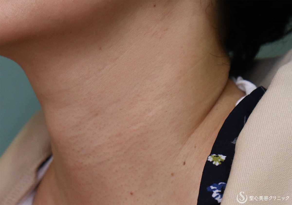 【50代女性・首の横じわ】プレミアムPRP皮膚再生療法（術後11か月） After 