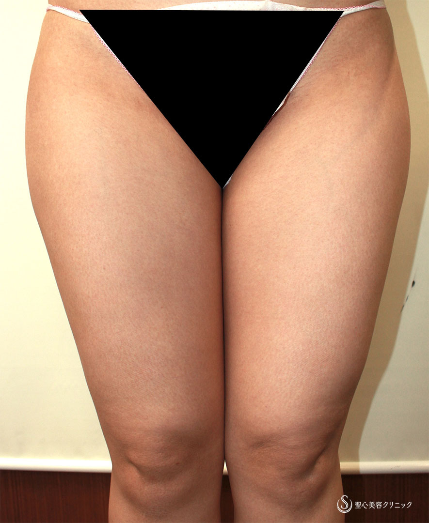 【20代女性・足太りを解消】ベイザーリポ脂肪吸引（大腿）（術後1ヶ月） Before 