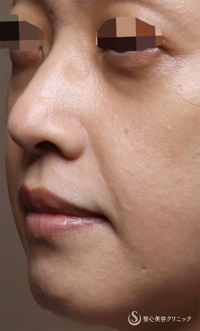 【40代女性・切らない目の下のクマ、ほうれい線若返り治療】プレミアムPRP皮膚再生療法（4ヶ月後） Before 