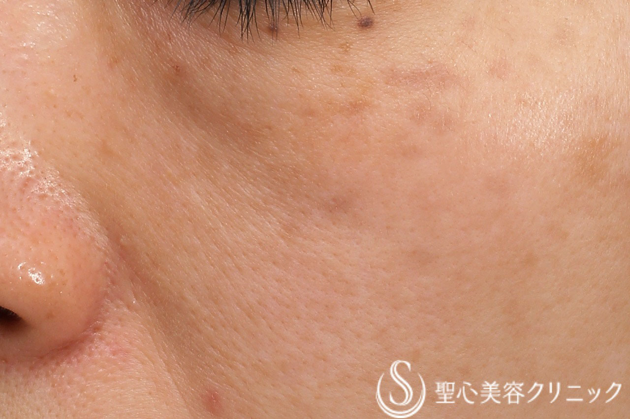 【40代女性・目の下の凹み】プレミアムPRP皮膚再生療法（6か月後） Before 