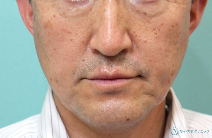 【50代男性・目の下の弛みに】プレミアムPRP皮膚再生療法（1か月後） After 