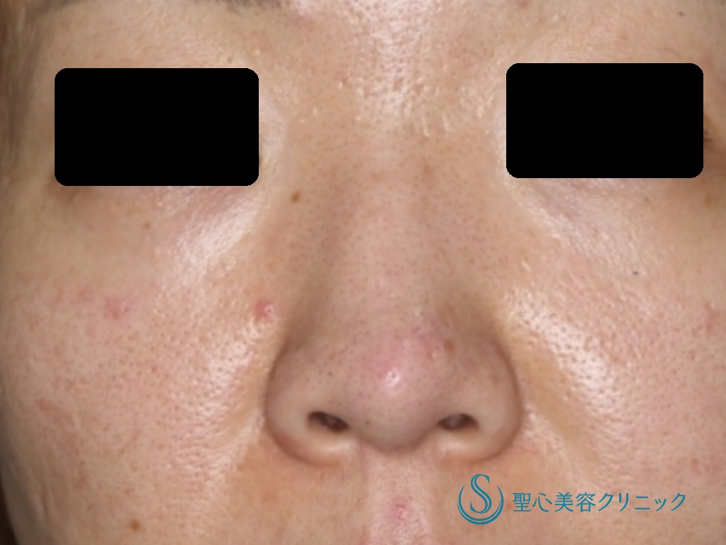 【30代女性・鼻を高く、きれいに】他院鼻のプロテーゼ入れ替え+鼻尖縮小+３DPCLドーム+小鼻縮小（+挙上）（術後1か月） Before 