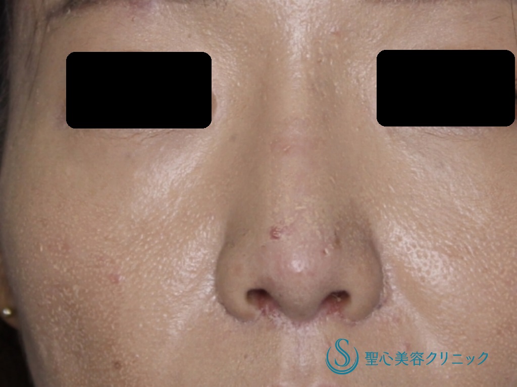 【30代女性・鼻を高く、きれいに】他院鼻のプロテーゼ入れ替え+鼻尖縮小+３DPCLドーム+小鼻縮小（+挙上）（術後1か月） After 