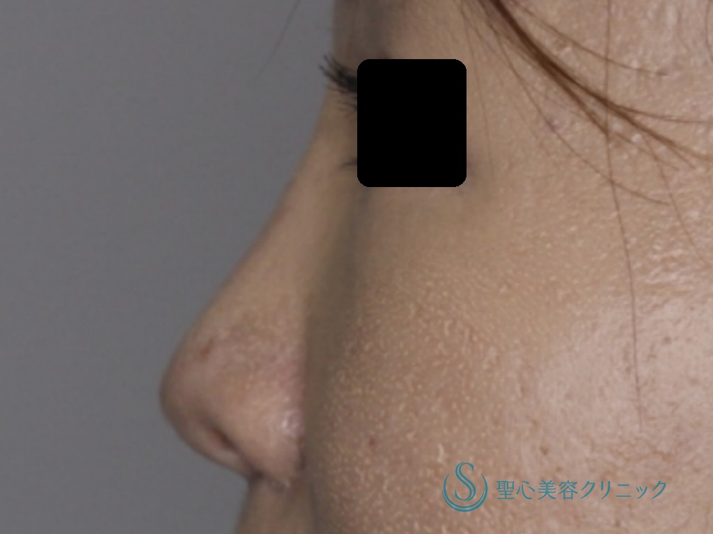 【30代女性・鼻を高く、きれいに】他院鼻のプロテーゼ入れ替え+鼻尖縮小+３DPCLドーム+小鼻縮小（+挙上）（術後1か月） After 