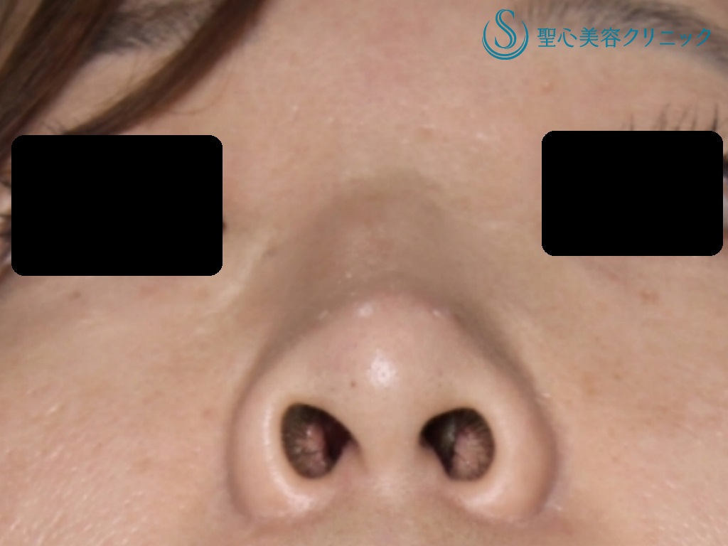 【30代女性・鼻を高く、きれいに】他院鼻のプロテーゼ入れ替え+鼻尖縮小+３DPCLドーム+小鼻縮小（+挙上）（術後1か月） Before 