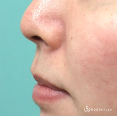 【20代女性・リップリフト】鼻下短縮術（リップリフト）（術後1か月） Before 