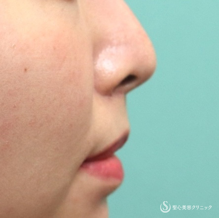 【20代女性・リップリフト】鼻下短縮術（リップリフト）（術後1か月） After 