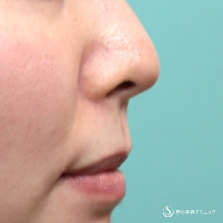 【20代女性・リップリフト】鼻下短縮術（リップリフト）（術後1か月） Before 