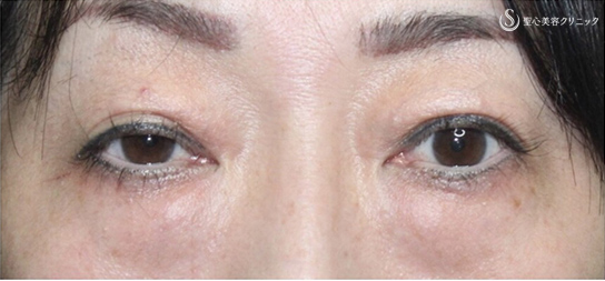 【40代女性・目周りを全体的に綺麗に】眼瞼下垂症手術＋眉下リフト＋経結膜下脱脂術（術後4ヶ月） Before 